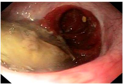 Impactaci&oacute;n alimentaria.