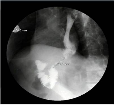 Radiograf&iacute;a de las v&iacute;as digestivas altas.