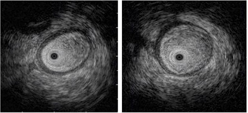 Edema de la pared del asa intestinal, observada en una ultrasonograf&iacute;a endosc&oacute;pica, mediante una minisonda.