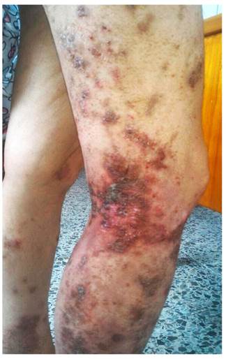 Se presentaron placas eritematosas costrosas y pardoeri-tematosas en las extremidades.