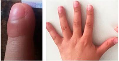 Hipocratismo digital documentado inicialmente (izquierda), y en mejor&iacute;a posterior al tratamiento insaturado (derecha).