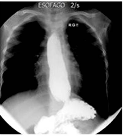 Radiograf&iacute;a de las v&iacute;as digestivas altas, con aumento del di&aacute;metro del es&oacute;fago, reflujo severo y alteraci&oacute;n del peristaltismo con ondas terciarias.