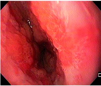Endoscopia de las v&iacute;as digestivas altas, con esofagitis grado D (seg&uacute;n la clasificaci&oacute;n de los &Aacute;ngeles).