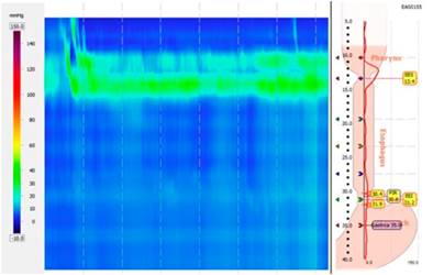 Manometr&iacute;a esof&aacute;gica de alta resoluci&oacute;n. Se observa el esf&iacute;nter esof&aacute;gico inferior casi imperceptible por hipoton&iacute;a y aperistalsis esof&aacute;gica.