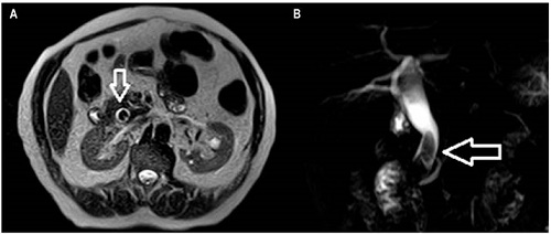 CRM. A. Corte coronal en el que se observa el c&aacute;lculo de gran tama&ntilde;o, que ocupa completamente la luz el col&eacute;doco. B. Reconstrucci&oacute;n tridimensional en la cual se observan los 2 c&aacute;lculos facetados y la dilataci&oacute;n del col&eacute;doco.