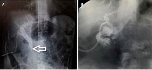 A. Se observa la dilataci&oacute;n de la v&iacute;a biliar y el c&aacute;lculo gigante que impide el paso del medio al duodeno. B. Colangiograf&iacute;a luego de la instrumentaci&oacute;n conjunta, sin que se encuentren los defectos de llenado ni el adecuado paso del medio al duodeno.