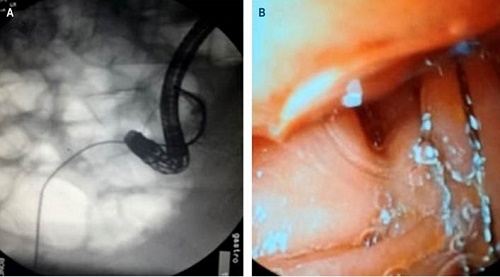 A. Fluoroscopia de la instrumentaci&oacute;n conjunta. B. Visi&oacute;n duodenosc&oacute;pica de la canastilla de Dormia avanzada por el tubo en T.