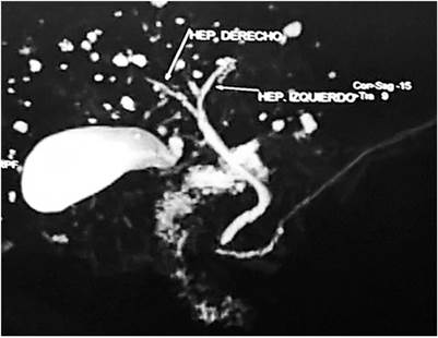 M&uacute;ltiples dilataciones saculares que comprometen las v&iacute;as biliares intrahep&aacute;ticas en toda la extensi&oacute;n del par&eacute;nquima hep&aacute;tico. La v&iacute;a biliar extrahep&aacute;tica se mantiene conservada, sin evidenciarse dilataciones a ese nivel. Se observa barro biliar en la ves&iacute;cula, sin determinar c&aacute;lculos.