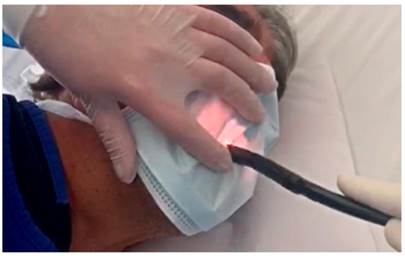 Procedimiento endoscópico. Fuente: imágenes propias de los autores.