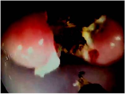 Divert&iacute;culo de Zenker con el diverticulotomo separando claramente el tabique, el cual se ha cortado con el bistur&iacute; de punta.