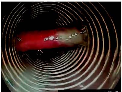 Diverticulotomo dise&ntilde;ado en nuestra unidad.