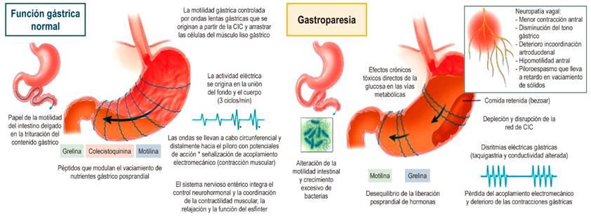 Características fisiopatológicas de la gastroparesia. CIC: células intersticiales de Cajal. Adaptado de: Reddymasu SC, Sarosiek I, McCallum RW. Severe gastroparesis: medical therapy or gastric electrical stimulation. Clin Gastroenterol Hepatol. 2010;8(2):117-24.