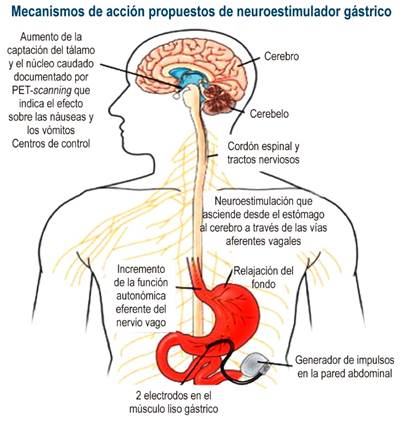 Dispositivo gástrico de estimulación eléctrica. PET: tomografía por emisión de positrones. Adaptado de: Reddymasu SC, Sarosiek I, McCallum RW. Severe gastroparesis: medical therapy or gastric electrical stimulation. Clin Gastroenterol Hepatol. 2010;8(2):117-24.