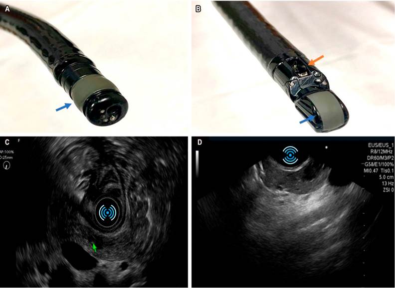 A. Equipo con transductor radial: la visi&oacute;n endosc&oacute;pica es frontal, la imagen sonogr&aacute;fica es radial; la flecha azul se&ntilde;ala el transductor radial. B. Transductor lineal: visi&oacute;n endosc&oacute;pica oblicua, visi&oacute;n sonogr&aacute;fica sectorial; la flecha azul se&ntilde;ala el transductor y la flecha naranja se&ntilde;ala el canal de trabajo que queda en disposici&oacute;n perpendicular en relaci&oacute;n con el transductor. C. Visi&oacute;n sonogr&aacute;fica radial, documentaci&oacute;n de una lesi&oacute;n hipoecoica ovalada en el cuello del p&aacute;ncreas compatible con tumor neuroendocrino. D. Visi&oacute;n con transductor lineal de la misma lesi&oacute;n en el cuello del p&aacute;ncreas.