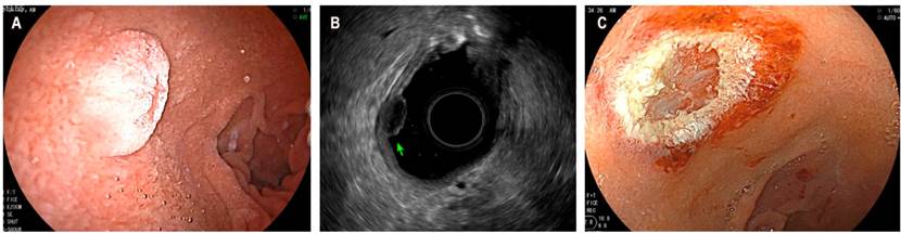 A. Visi&oacute;n endosc&oacute;pica de un tumor neuroendocrino en el bulbo duodenal. B. Visi&oacute;n sonogr&aacute;fica. C. Resecci&oacute;n mediante mucosectom&iacute;a. Im&aacute;genes cortes&iacute;a del Dr. Carvajal, Hospital Pablo Tob&oacute;n Uribe (HPTU).