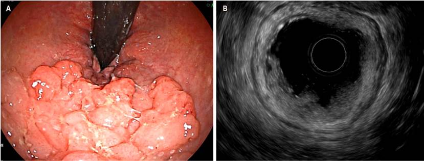 A. Visi&oacute;n endosc&oacute;pica en retroflexi&oacute;n de una lesi&oacute;n con extensi&oacute;n lateral en el recto distal. B. Lesi&oacute;n mucosa, con extensi&oacute;n hasta la submucosa (uT1 sm). Imagen cortes&iacute;a del Dr. Carvajal, HPTU.