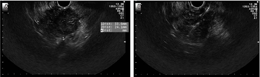 A. Lesi&oacute;n s&oacute;lida en la cabeza del p&aacute;ncreas. B. PAAF de la lesi&oacute;n. Imagen cortes&iacute;a del Dr. Ca&ntilde;adas, Cl&iacute;nica Marly.