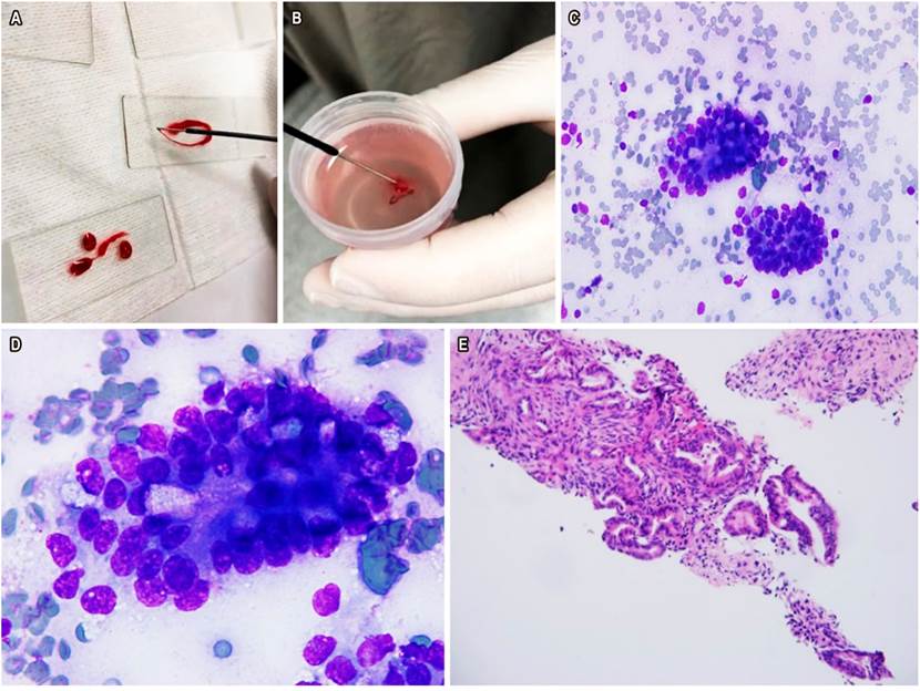 A. Extendido de tejido pancre&aacute;tico en sala de endoscopia. B. BAAF colocada en un frasco con formol. C. Citolog&iacute;a con Diff-Quick 40x: evidencia de adenocarcinoma ductal de p&aacute;ncreas. D. Citolog&iacute;a Diff-Quick 100x con adenocarcinoma ductal. E. BAAF con evidencia de adenocarcinoma ductal. Imagen cortes&iacute;a del Dr. Mosquera-Klinger, HPTU.