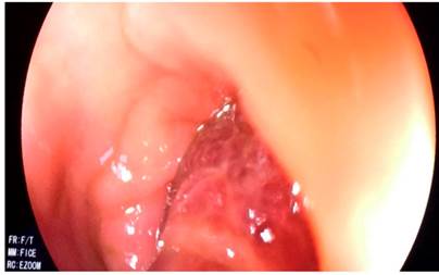 Gran p&oacute;lipo pediculado del colon.