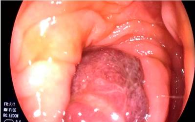 P&oacute;lipo del colon que ocluye en su totalidad la luz col&oacute;nica.
