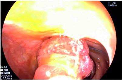 Paso del lazo hemost&aacute;tico (endoloop) previo a la polipectom&iacute;a.