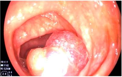 Recuperaci&oacute;n del p&oacute;lipo del colon resecado.