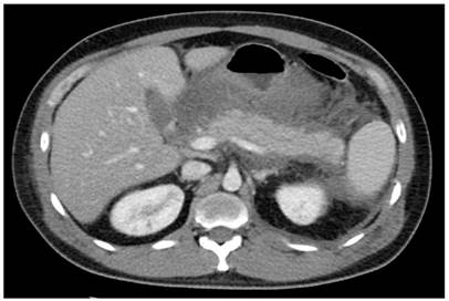 TAC de abdomen. Pancreatitis intersticial edematosa asociada con múltiples colecciones peripancreáticas apicales.