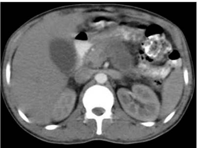 TAC abdominal: hepatomegalia e infiltraci&oacute;n grasa, pancreatitis (Balthazar D) con &iacute;ndice de severidad 5, derrame pleural bilateral y escasa cantidad de l&iacute;quido libre en la cavidad abdominal. Fuente: archivo de los autores.