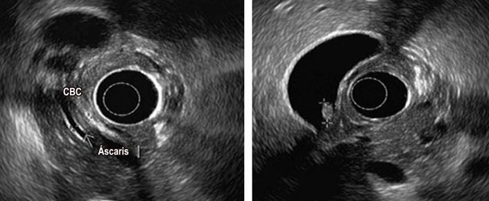 Ultrasonograf&iacute;a endosc&oacute;pica biliopancre&aacute;tica: colelitiasis, v&iacute;a biliar con Ascaris lumbricoides en su interior. CBC: conducto biliar com&uacute;n. Fuente: archivo de los autores.