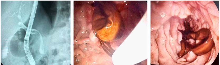 CPRE: v&iacute;a biliar levemente dilatada de 7 a 8 mm, con defecto de llenado alargado e imagen en doble riel, por presencia de &aacute;scaris. Fuente: archivo de los autores.