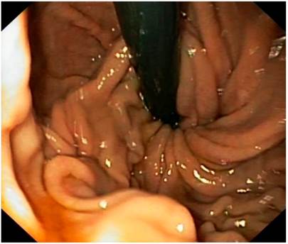 Imagen endosc&oacute;pica en retroversi&oacute;n de la fundoplicatura durante el ingreso.