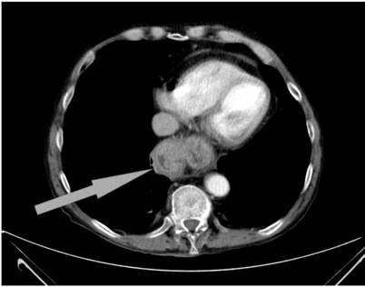 Imagen radiol&oacute;gica de TAC en la que se se&ntilde;ala el acodamiento de la fundoplicatura.