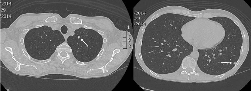 Se observa un n&oacute;dulo pulmonar con calcificaciones gruesas en el segmento apicoposterior del l&oacute;bulo superior izquierdo, de 6 mm de di&aacute;metro, y otra imagen nodular subpleural de 6 mm de di&aacute;metro, en el segmento superior del l&oacute;bulo inferior izquierdo, con densidad de tejidos blandos. Fuente: archivo de los autores.