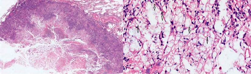Con coloraci&oacute;n de hematoxilina-eosina, se observa el par&eacute;nquima pulmonar con un granuloma necrotizante, con detritos e histiocitos. A mayor aumento (10 X), se aprecian en detalle las esporas del criptococo, se&ntilde;aladas con flechas. Fuente: archivo de los autores.