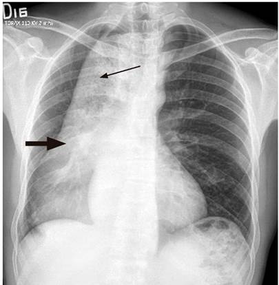 Radiograf&iacute;a de t&oacute;rax, proyecci&oacute;n posteroanterior (PA). Masa mediastinal que se extiende hacia la derecha y posterior al mediastino (flecha gruesa). Nivel hidroa&eacute;reo irregular y contenido de opacidad heterog&eacute;nea, sugestiva de alimento (flecha delgada). Fuente: Unidad de Gastroenterolog&iacute;a. Hospital Universitario San Ignacio. Bogot&aacute; D.C. Colombia.