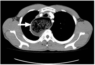 TAC de t&oacute;rax contrastado. Dilataci&oacute;n esof&aacute;gica, con di&aacute;metro transverso m&aacute;ximo de 7 cm, de paredes tortuosas. Material heterog&eacute;neo, sugestivo de contenido alimentario (flecha gruesa). Fuente: Unidad de Gastroenterolog&iacute;a. Hospital Universitario San Ignacio. Bogot&aacute; D.C. Colombia.
