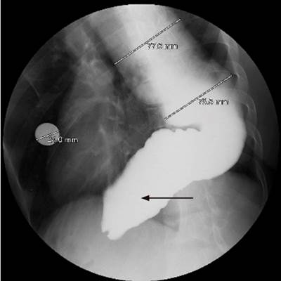 Esofagograma con bario. Uni&oacute;n gastroesof&aacute;gica por debajo del hemidiafragma izquierdo, en la que se identifica una alteraci&oacute;n en la relajaci&oacute;n del esf&iacute;nter esof&aacute;gico inferior, lo que condiciona el retraso en su vaciamiento. Aspecto sigmoide de es&oacute;fago distal (flecha delgada). Fuente: Unidad de Gastroenterolog&iacute;a. Hospital Universitario San Ignacio. Bogot&aacute; D.C. Colombia.