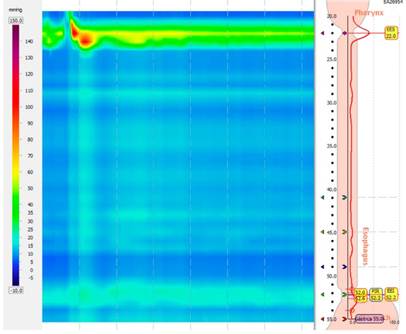 Manometr&iacute;a de alta resoluci&oacute;n. Acalasia tipo I o cl&aacute;sica (con IRP elevada mayor de 15 mm Hg y 100 % de degluciones fallidas). Fuente: Unidad de Gastroenterolog&iacute;a. Hospital Universitario San Ignacio. Bogot&aacute; D.C. Colombia.