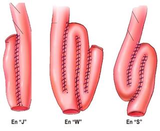 Principales tipos de reservorio. Modificado de referencia 7.