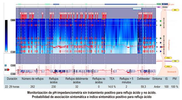 Estudio de monitorizaci&oacute;n de pH-impedanciometr&iacute;a de 24 horas sin tratamiento. EES: esfinter esof&aacute;gico superior; PIR: punto de inversi&oacute;n respiratorio. Fuente: propiedad de los autores.