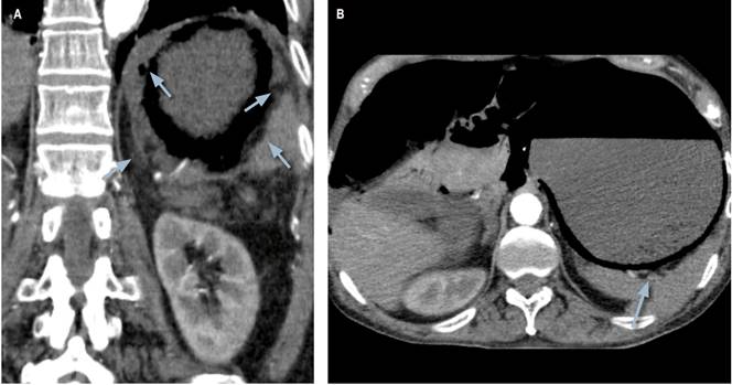 Tomograf&iacute;a abdominal con contraste del paciente. Se observa sobredistensi&oacute;n de la c&aacute;mara g&aacute;strica y hallazgos compatibles con infiltraci&oacute;n de gas en las paredes del est&oacute;mago. Las flechas se&ntilde;alan la presencia de burbujas de gas en la pared estomacal.