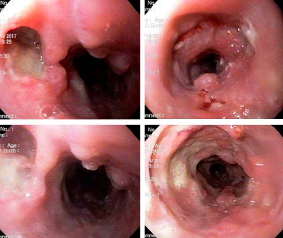 Los hallazgos sugieren tuberculosis gastrointestinal.