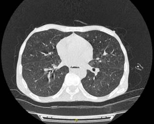 N&oacute;dulos centrolobulillares con opacidad de &aacute;rbol en gemaci&oacute;n.