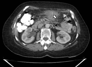 TAC de abdomen contrastado.