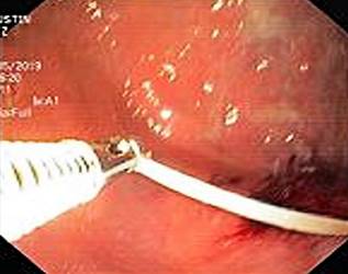 Endoscopia digestiva alta.
