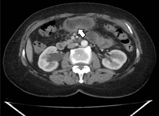 TAC de abdomen contrastado de control.