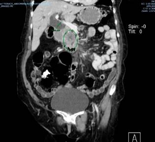 Masa de la cabeza del páncreas, obstrucción de la vía biliar distal.