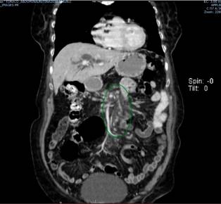 Aumento de la densidad de la grasa mesentérica con adenopatías subyacentes.