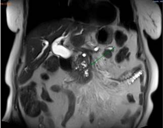 Masa de la cabeza del páncreas, dilatación de la vía biliar intra- y extrahepática.