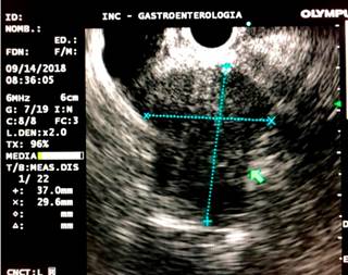 Visión por endosonografía de la masa en la cabeza de páncreas y dilatación de la vía biliar.